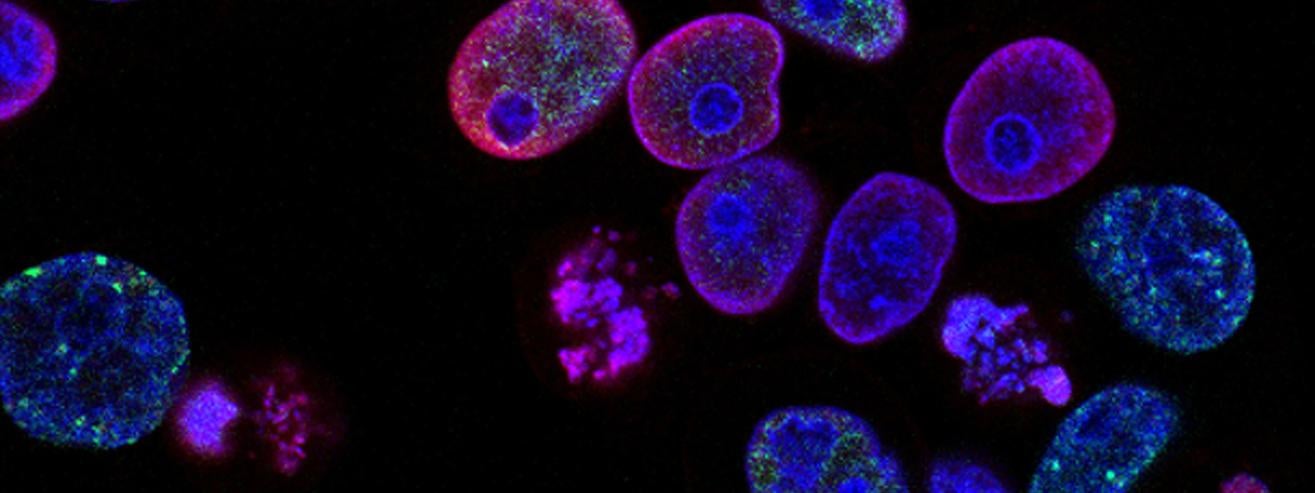 cancer cells treated with a topoisomerase inhibitor